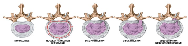 Herniated Disc Symptoms And Treatment Spine And Orthopedic Center