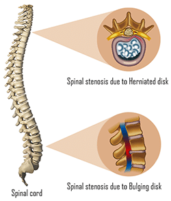 Spinal stenosis - causes, symptoms and treatment