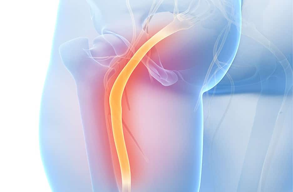 Sciatica and What you need to know