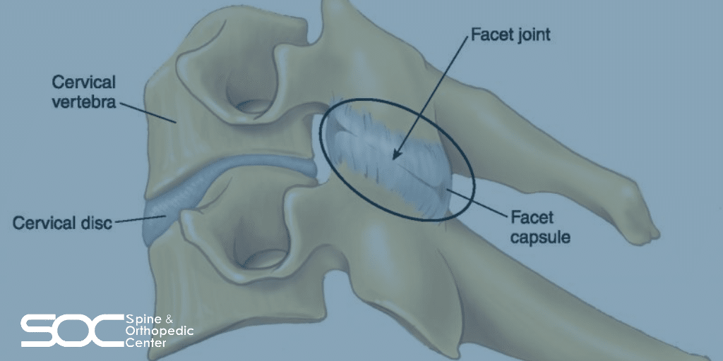 neck facet syndrome symptoms