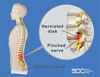 Pinched nerve in lower back: Causes & Treatment of nerve pain