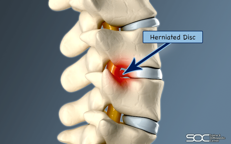 What surgical options are available for a herniated disc?