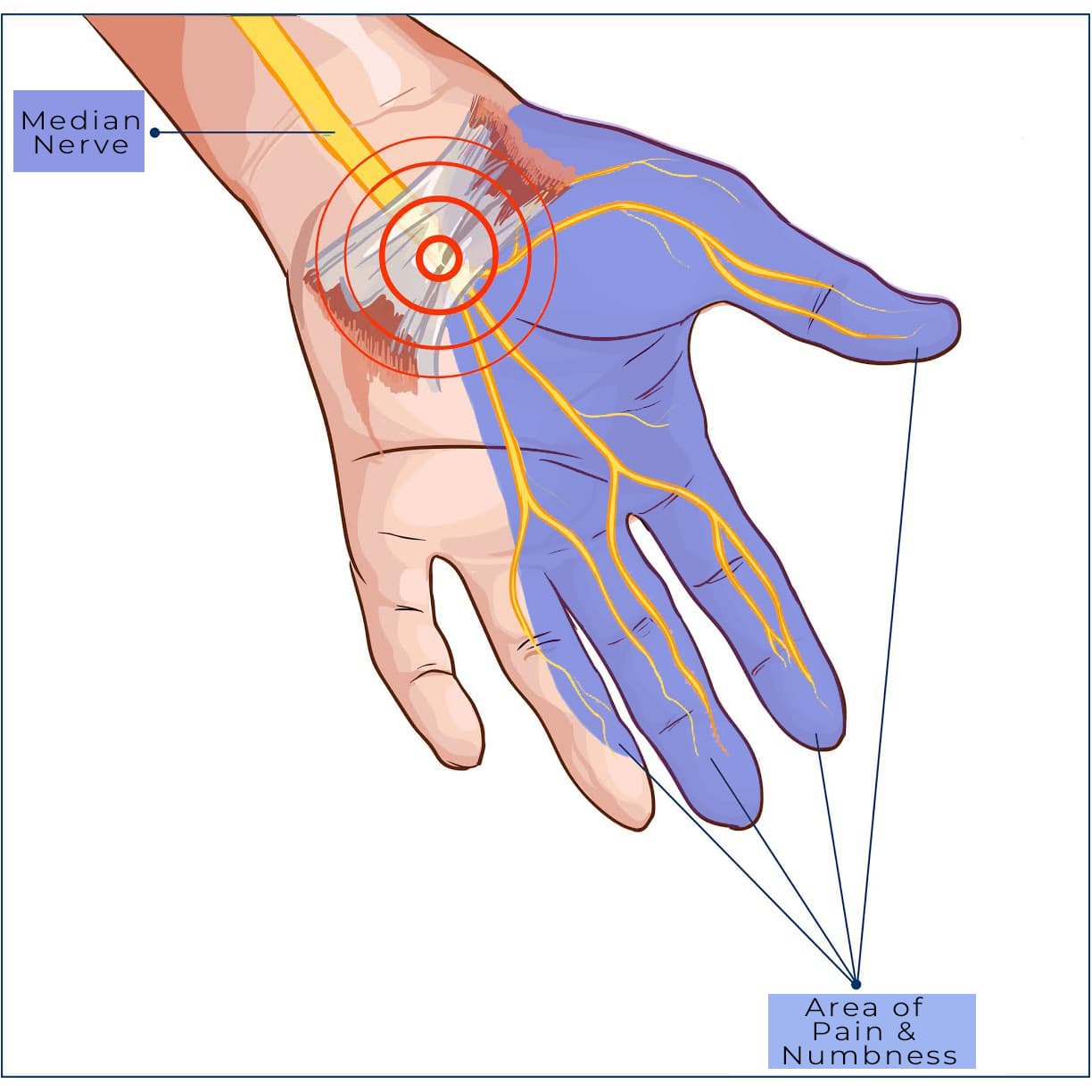 signs of carpal tunnel