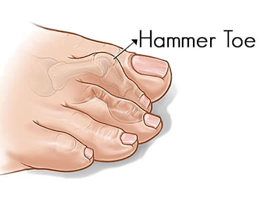 Hammertoe Treatment & Repair Surgery