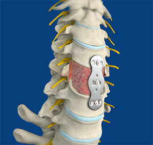 Cervical Corpectomy Spine Orthopedic Center