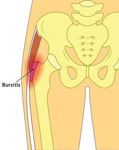 Hip Bursitis Treatment & Recovery